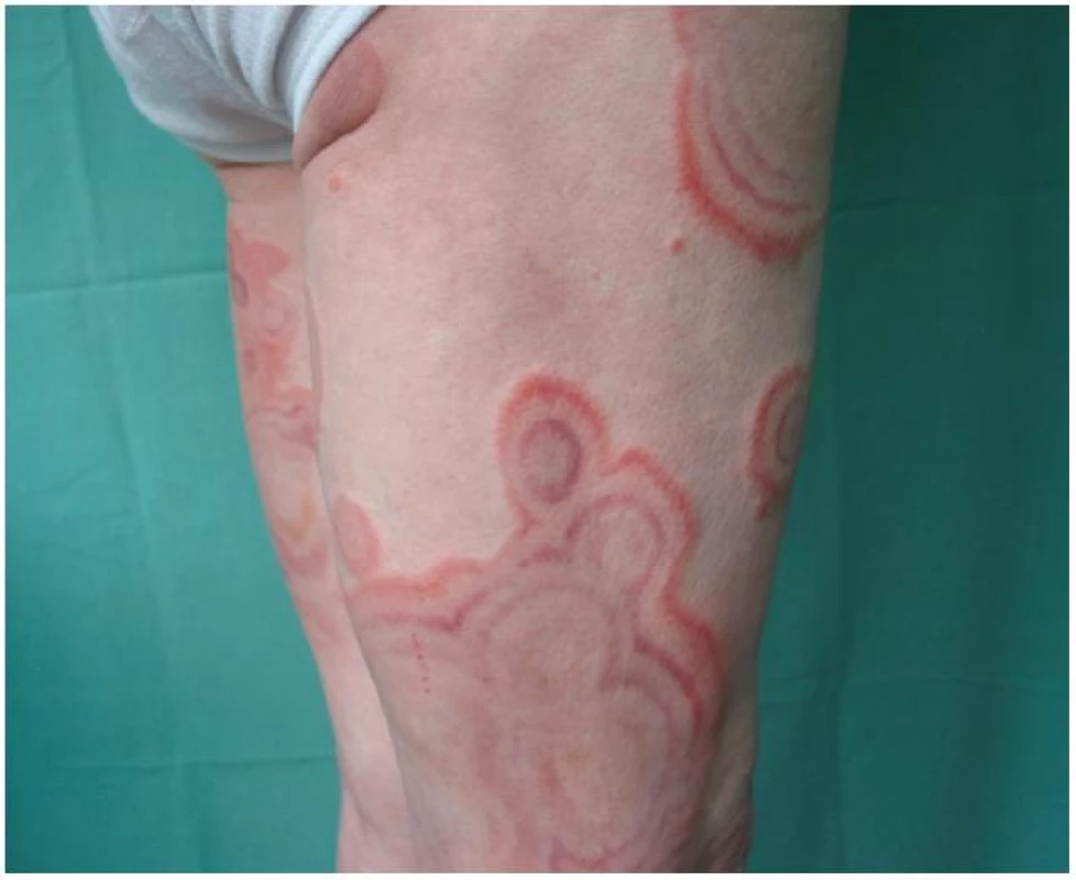 Erythema gyratum repens