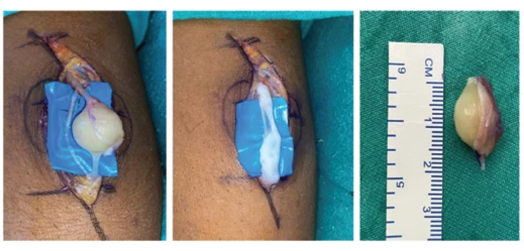 Schwannoma arising from left sural nerve. The tumor was arising from one of the sural nerve fascicle, which was sacrifi ced with the tumor and continuity was ensured using a vein graft harvested from the dorsum of the same foot.