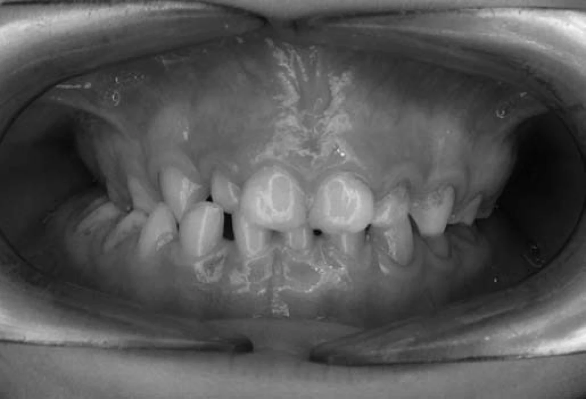 Pravostranne skrížený zhryz u pacienta č. 1 s núteným vedením sánky doprava v dôsledku zúženia horného zubného oblúka.
Fig. 2. Unilateral crossbite at the right side in patient No. 1 with forced bite as consequence of upper arch compression.