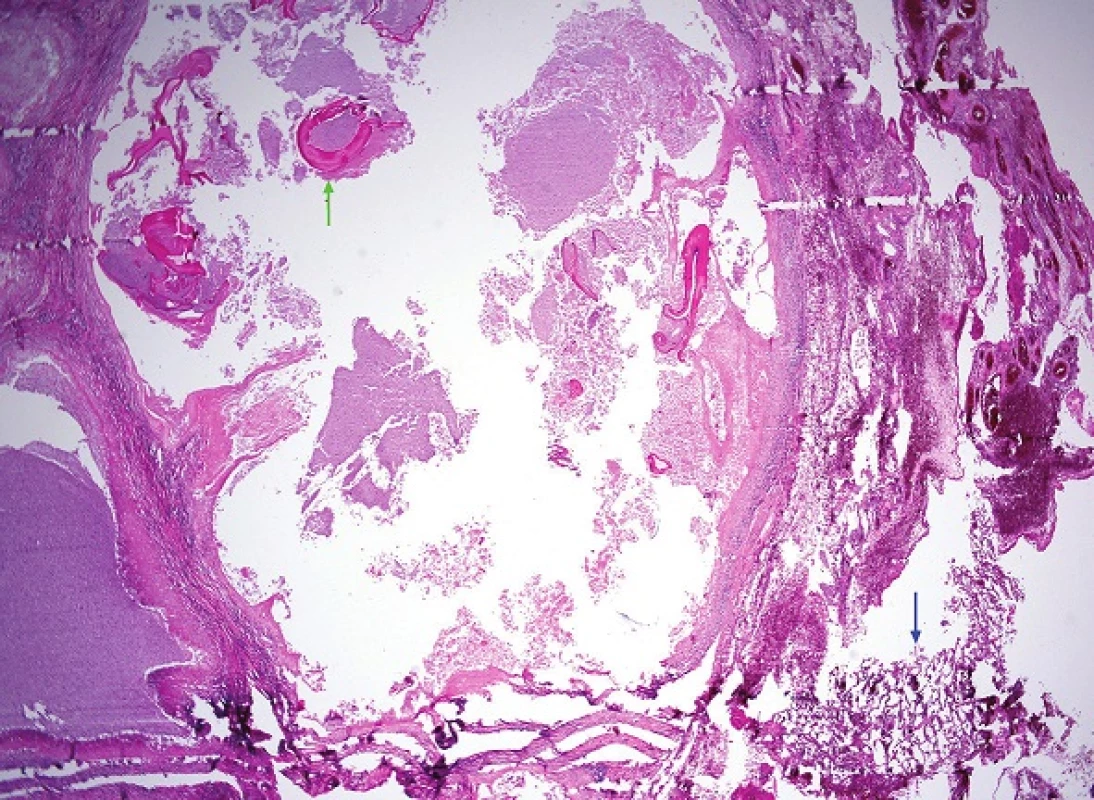 One of the cavities at the edge of the lung parenchyma (blue arrow) containing several detached fragments of laminar eosinophilic membranes that form the intermediate layer of the echinococcal cyst (one fragment is marked by the green arrow) (H&amp;E, 25x).