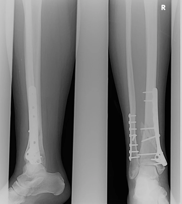 Osteosyntéza LCP podvlékanou dlahou
Fig. 9: Osteosynthesis using a Locking Compression Plate