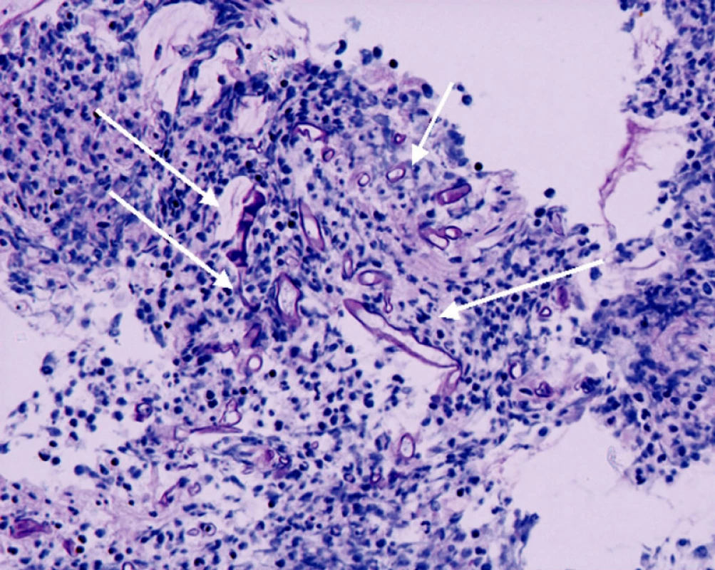 Histologický nález biopsie, šipky označují myotické hyfy
Fig. 4. Biopsy histological findings, the arrow marks the    myotic hyphae
