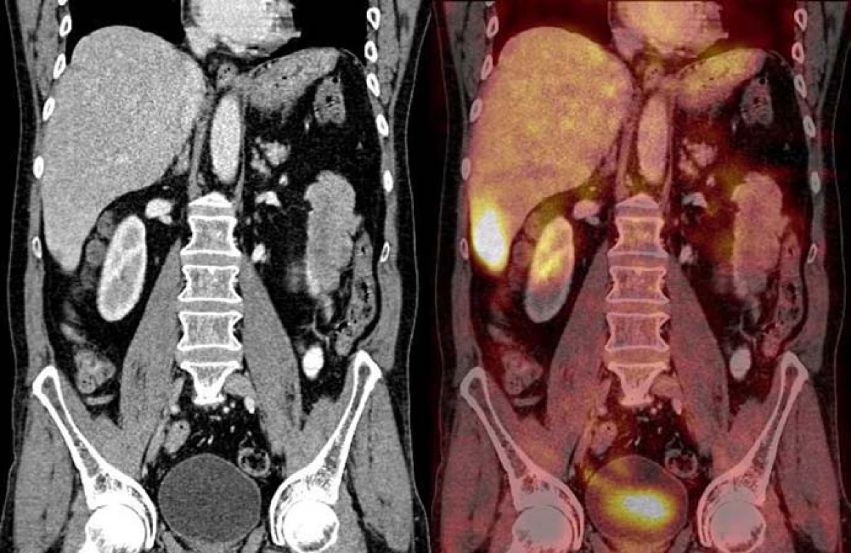 Relaps onemocnění – srpen roku 2008, zvýšená metabolická aktivita v játrech a lymfatických uzlinách retroperitonea – kazuistika č. 3.