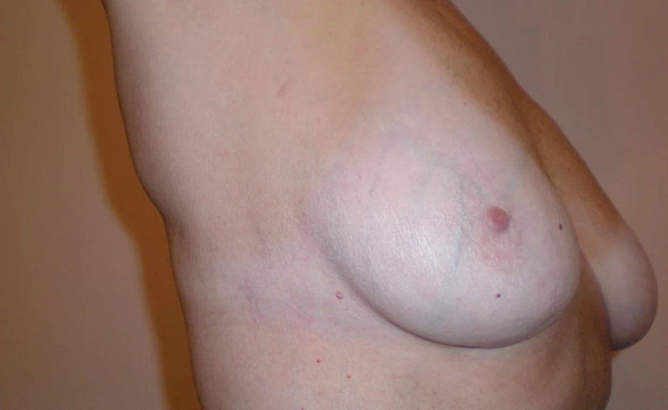Příznivý kosmetický výsledek rok po operaci defektu septa síní pomocí robotického systému