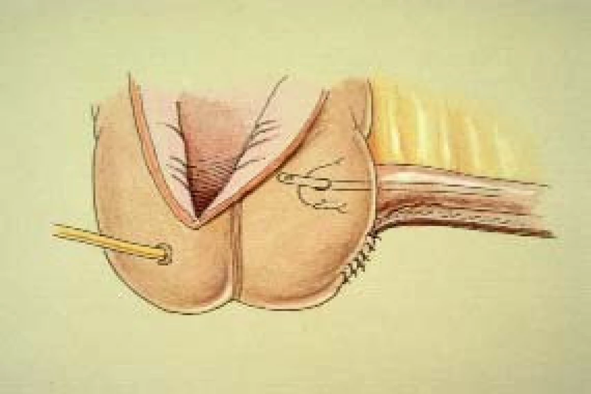 Tyto ilustrace zobrazují proceduru plikace ileocékální chlopně. 
a. Přes zahnutý segment sutury, pomocí níž bylo provedeno zúžení ileálního segmentu, je umístěna 3-0 hedvábná Lembertova sutura (obvykle 5–7 stehů). 
b. Tento nákres ukazuje umístění další plikační sutury. 
c. Tento snímek zachycuje plikační sutury před utažením. Povšimněte si, že stehy blíže ke stěně céka jsou širší než stehy na eferentní větvi. 
d. Po utažení plikačních stehů svírá eferentní větev se stěnou céka přibližně úhel 90 °. V tomto momentě je třeba vyzkoušet plikaci chlopně zavedením 18 F katétru eferentní větví. Při zavádění katétru ileocékální chlopní bychom měli pociťžovat mírný odpor. Pro dosažení tohoto odporu může být nutné umístění další sutury, nebo naopak její odstranění. Přítomnost odporu při zavádění 18 F katétru během operace obvyklesouvisí s dosažením dobré kontinence.