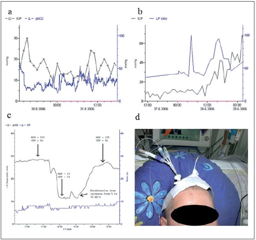 Multimodální monitorování u pacientů s edémem mozku.
Krátkodobé elevace ICP vedou k poklesům tkáňové oxymetrie. Pokles ICP vede k návratu ptiO<sub>2</sub> k původním hodnotám, střednědobý trend hodnot tkáňové oxymetrie je stabilní (a).
LP poměr u pacienta s rozvíjejícím se maligním edémem mozku. Po celou dobu sledování byla hodnota LP poměru vysoká (40) a postupně progredovala. Při rozvoji maligního edému (ICP narostlo z 15 na 40 mmHg) pak zároveň došlo k elevaci LP poměru na 60 (b). Vývoj tkáňové oxymetrie u pacientky s edémem mozku na podkladě intracerebrálního hematomu při ruptuře aneuryzmatu na bifurkaci ACM dx po pravostranné dekompresní kraniektomii. V průběhu tracheostomie bylo zvýšeno tlumení a došlo k poklesu perfuzního
tlaku na 54 mmHg. Tento pokles se projevil v poklesu tkáňové oxymetrie z 28 na 12 mmHg. Navýšení kontinuálně aplikovaného noradrenalinu z 18,8 na 27,5 μg/ kg/ min pak vedla opět k elevaci perfuzního tlaku 96 mmHg. Tato intervence vedla ke zvýšení tkáňové oxymetrie nad 20 mmHg (c). Pacient s kraniocerebrálním poraněním na anesteziologicko-resuscitačním oddělení. Zprava jsou aplikována čidla k monitorování ICP, tkáňové oxymetrie a tkáňového metabolizmu. Zleva pak byla aplikována zevní komorová
drenáž (d).