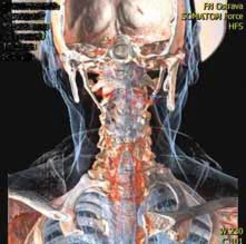 3D reconstruction of CT scans in a patient with left-sided SP elongation.