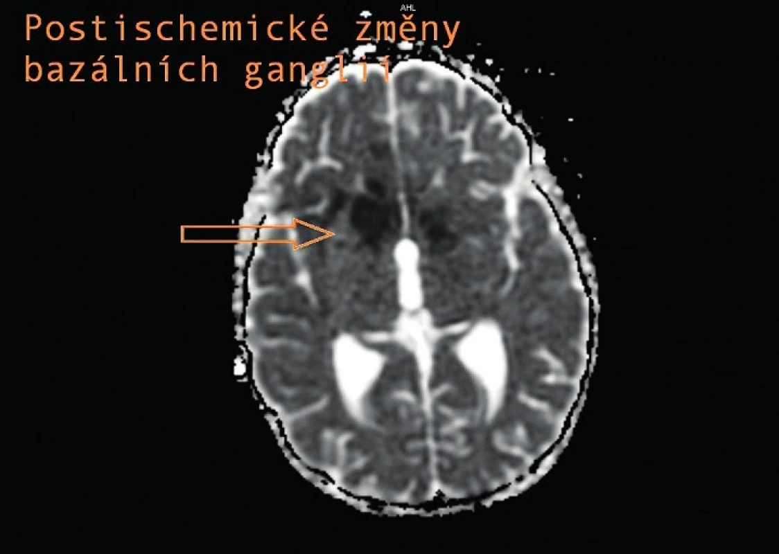 Postischemické změny bazálních ganglií.
Fig. 5. Postischemic changes of the basal ganglia.