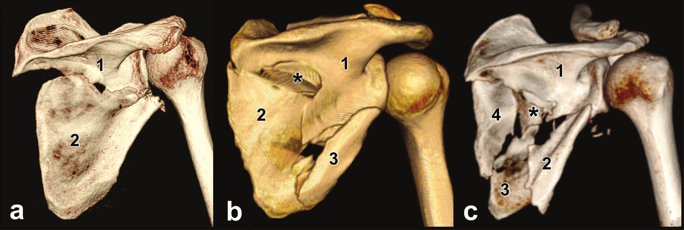 Types of lateral pillar fracture
a – two-part fracture, 1 – superior fragment, 2 – inferior fragment; b – three-part fracture, 1 – superior fragment, 2 – medial fragment, 3 – lateral fragment, * – intercalary fragment; c – comminuted fracture, 1 – superior fragment, 2 – lateral fragment, 3 – inferior fragment, 4 – medial fragment, * – intercalary fragment.