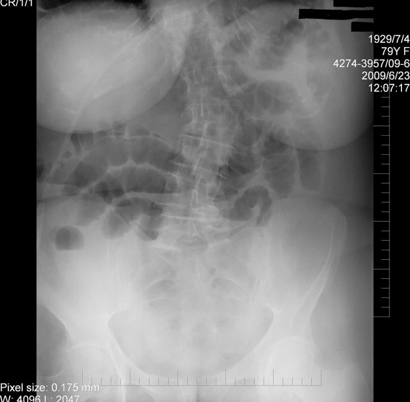 Ileus tenkých kliček způsobený obstrukcí kamenem