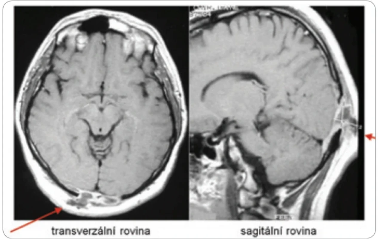 LCH postihuje velmi často lebeční kosti, ale může postihnout kteroukoliv kost v těle. Kostní ložiska LCH mají osteolytický charakter, ale tumorozní hmoty mohou expandovat do okolí kosti a způsobovat hmatné zduření, pokud expandují zevně. Na MR zobrazení je zřetelný osteolytický proces okcipitálně, který expandoval jak vně kosti (pacient udával v tom místě hmatné zduření), tak do nitra kalvy a komprimoval šedou kůru mozkovou v oblasti zrakového centra, což se projevilo poruchou zraku. Po léčbě kladribinem je vše v normě a pacient je > 10 let v remisi. K podobné osteolýze s expanzí zevně i dovnitř může dojít v kterékoliv lebeční kosti.