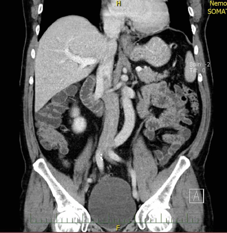 CT břicha, suspektní tumor céka Fig. 1: Abdominal CT, suspected cecal tumor