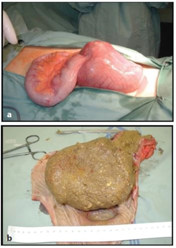 Dilatované rektosigmoideum objemným fekalomem a); s místem perforace b) u prvého pacienta.
Fig. 2: Dilated rectosigmoid due to a huge fecaloma a); and the site of perforation b) in the first patient.