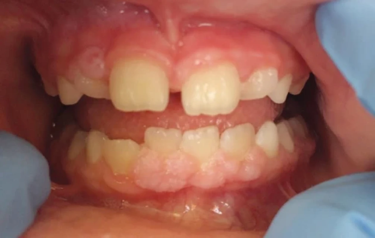 Hypertrofie gingivy ve frontálním úseku horní i dolní čelisti ve věku šest let. Zdroj: Dokumentace pacientky. Fig. 1 Hypertrophy of gingiva in the anterior region of the upper and lower jaw at the age of 6 years. Source: Patient’s medical records.