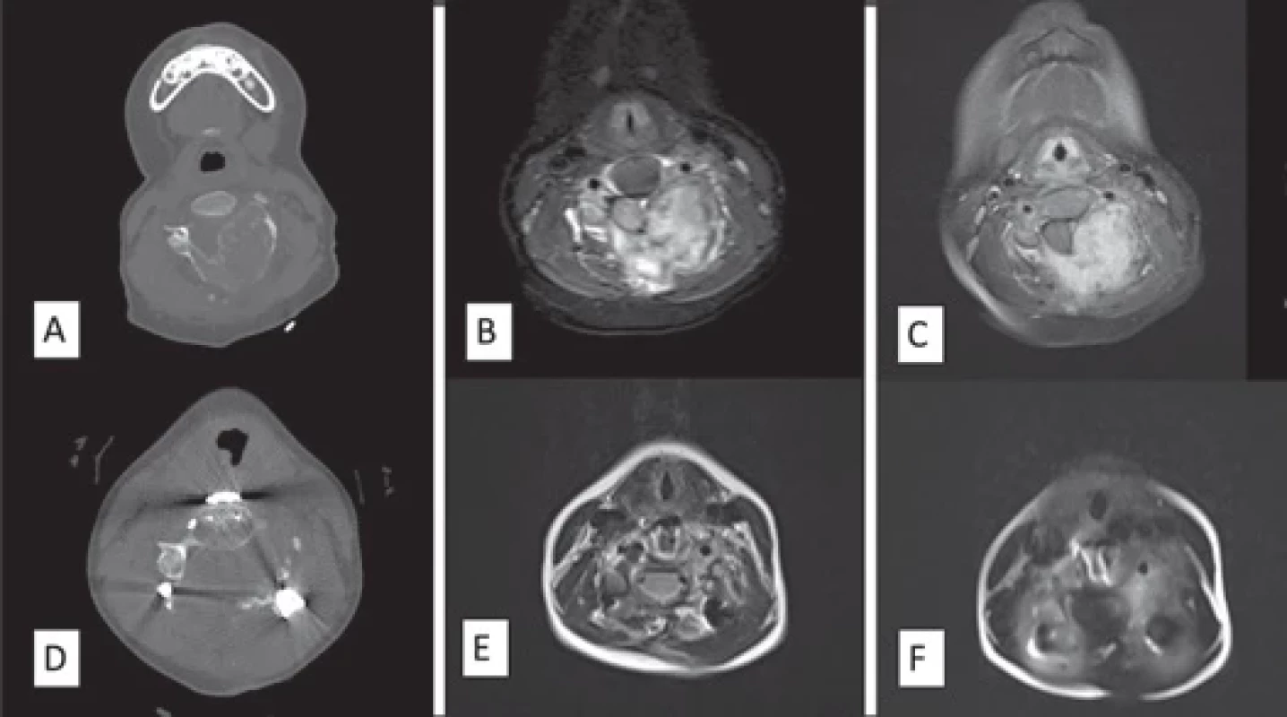 Images of the patient with recurrent osteoblastoma (Patient 11) after recurrence: (A) axial CT image; (B) axial T2-weighted MRI image; (C) axial postcontrast T1-weighted MRI image; (D) postoperative axial CT image; (E) postoperative axial T2-weighted MRI image; (F) postoperative axial postcontrast T1-weighted MRI image.