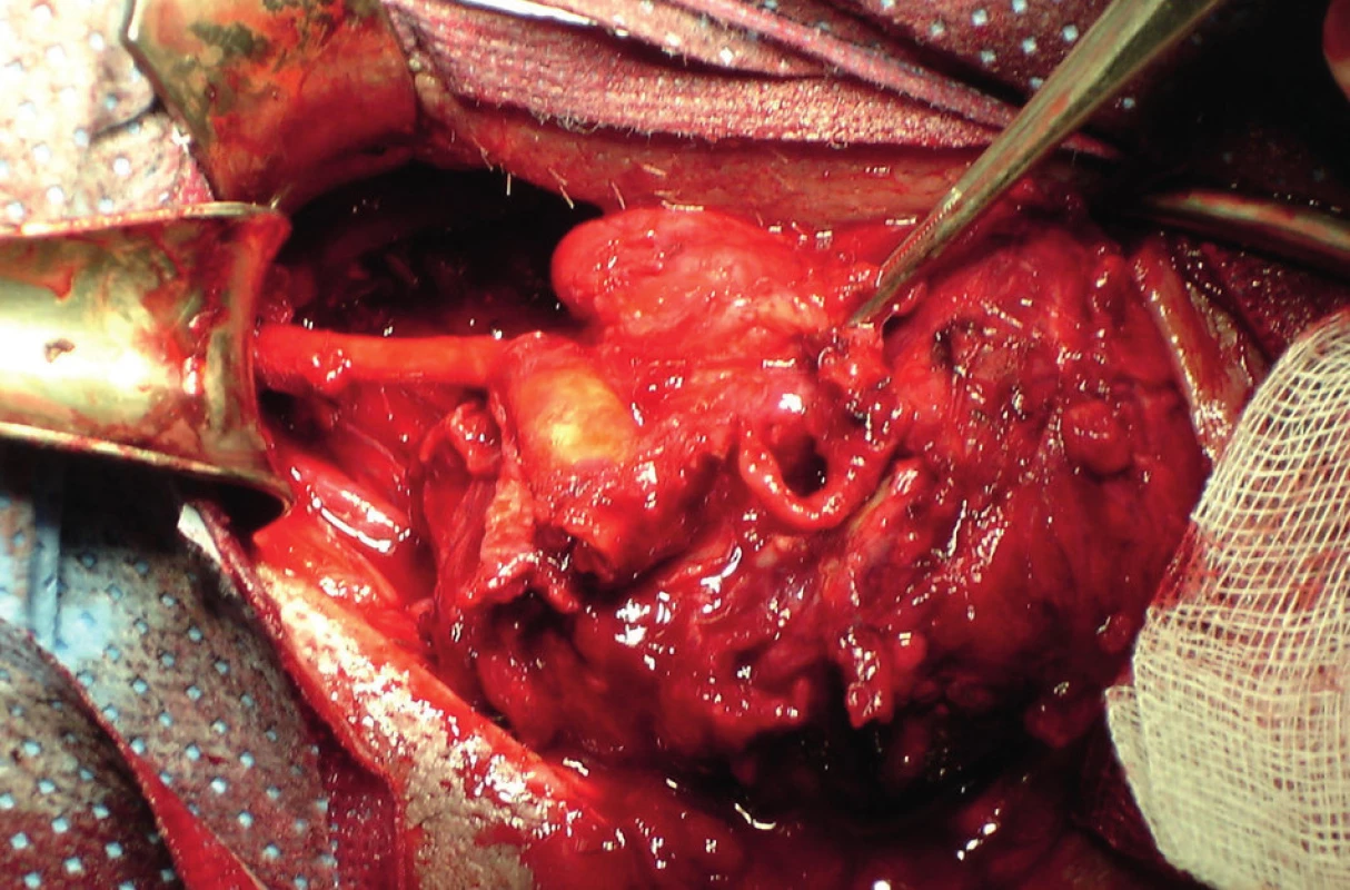 Po přetočení tumoru v podélné ose patrný průběh ACI.
Fig. 6: After turning the tumour in the longitudinal axis, ICA course is evident