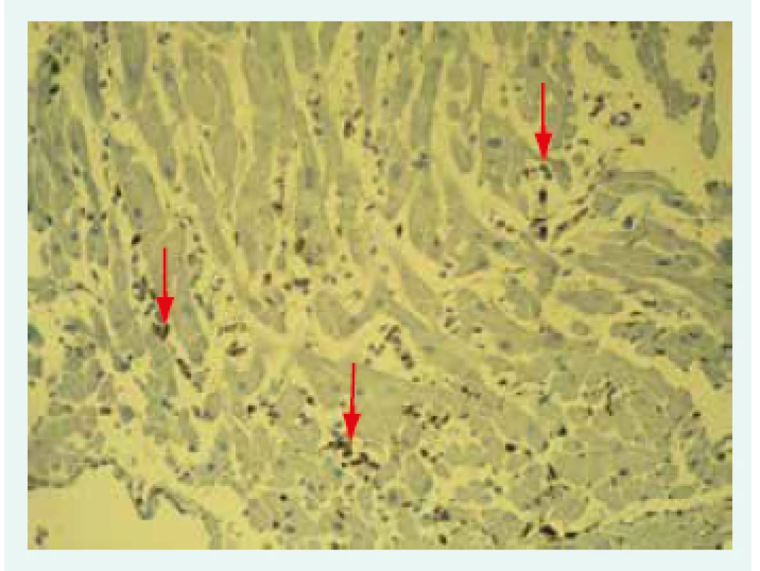 Imunohistochemické vyšetření mononukleárních leukocytů: infiltrát označen šipkami.