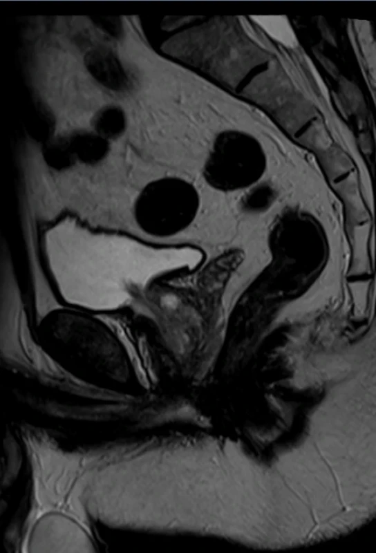 MR malé pánve s kontrastem, sagitální řez. Fig. 3. Contrast-enhanced MRI of the pelvis, sagittal section. 