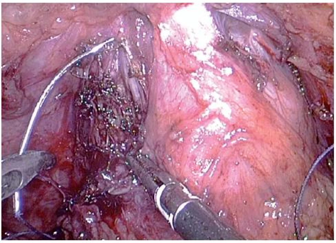 Opich komplexu dorsální vény
Fig. 4. The ligation of a dorsal vein complex