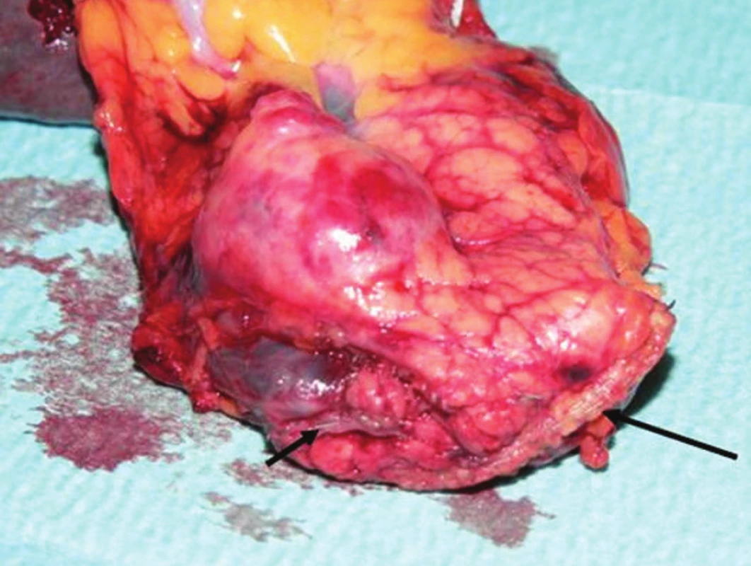 Resekčná línia so svorkami (veľká šípka), svorky na staplerom preťatej trombotizovanej a lienalis (malá šípka)
Fig. 2. Resection line with clips (large arrow), clips on the thrombotized lienal artery, cut with a stapler (small arrow)