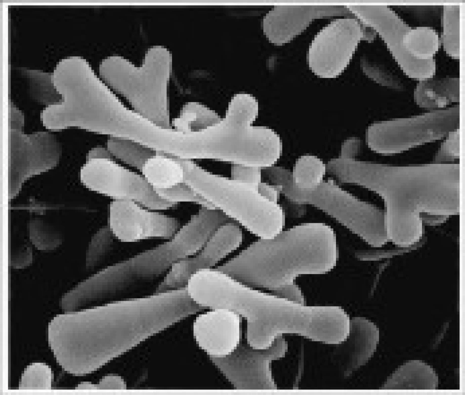 Bifidobacterium species – mikroskopie. 
Internetový zdroj: <a href="http://oncologiaesalute.files. worldpress.com">http://oncologiaesalute.files. worldpress.com</a>
