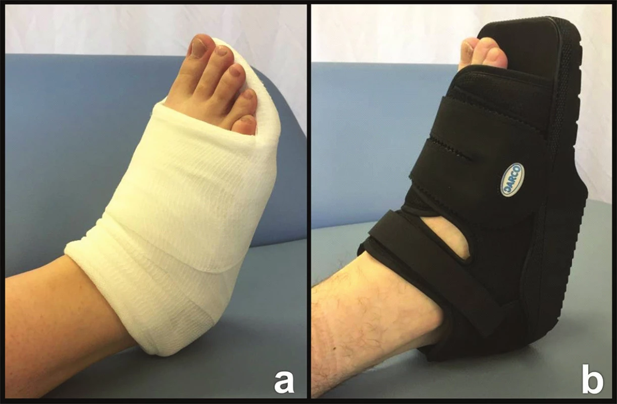 Možnosti fixace nohy
a − Essex-Loprestiho střevíc; b − Barouk bota.
Fig. 5: Options of foot fixation
a− Essex-Lopresti shoe; b − Barouk boot.
