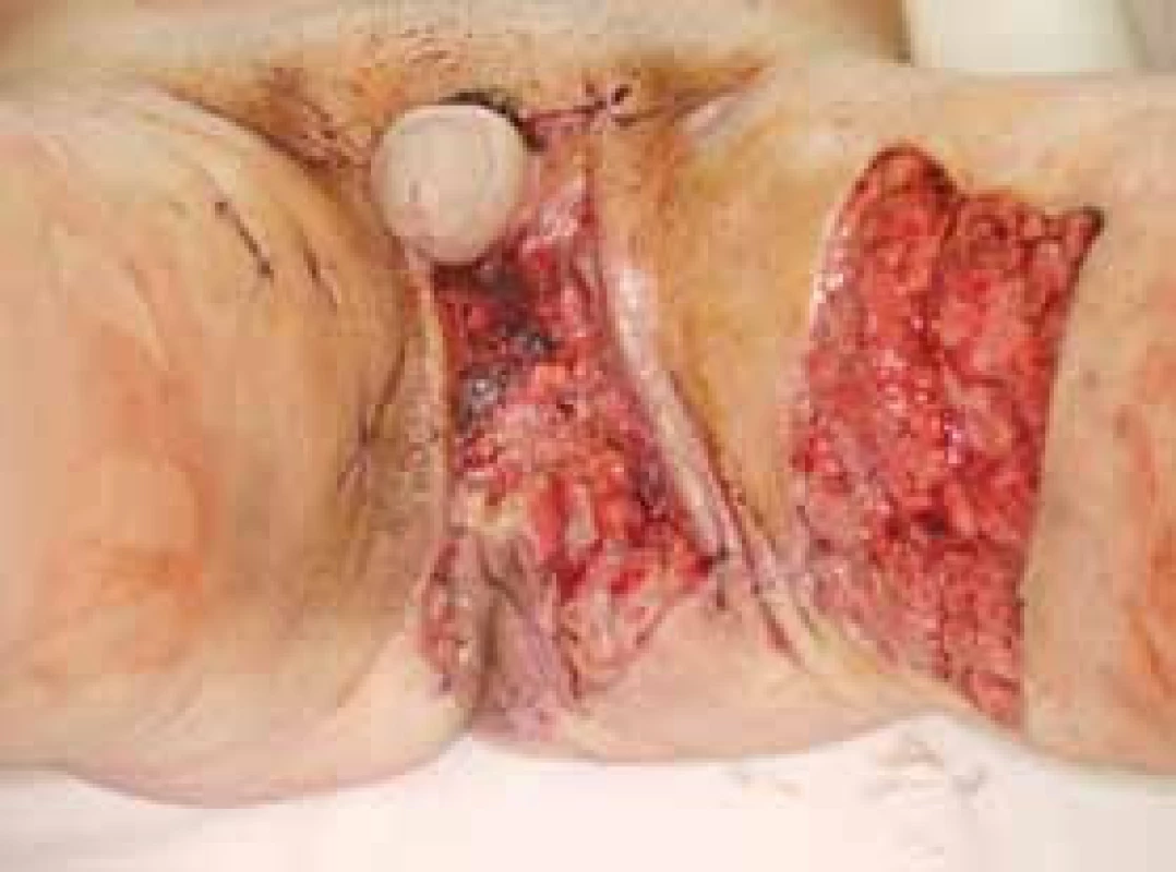 Osmý pooperační den
Je patrný lymfedém ponechaného vnitřního listu předkožky.
Fig. 4.
The 8th postoperative day
The lymphoedoma of the internal prepuce is retained.