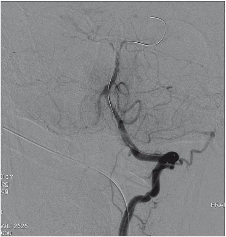 Rekanalizace bazilární tepny po 35 minutách insonace a intraarteriální trombolytické léčby systémem Eko-Sonic SV<sup>TM</sup>.