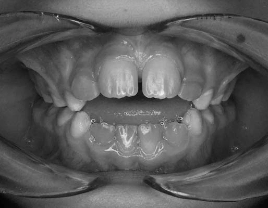 Otvorený zhryz u pacienta č. 2.
Fig. 4. Open bite in patient No. 2.