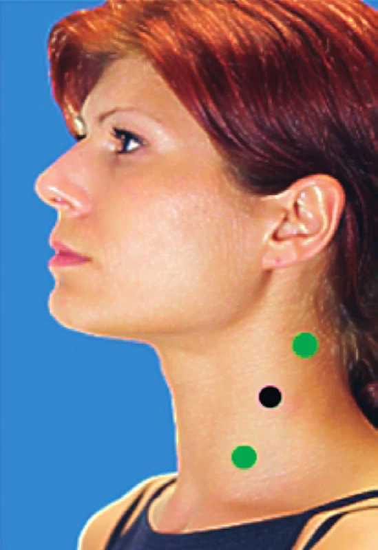 Umiestnenie elektród v oblasti m. sternocleidomastoideus. Obrázky sú kopírované z databázy prístroja Biofeedback 2000 x-pert, od firmy Schuhfried.