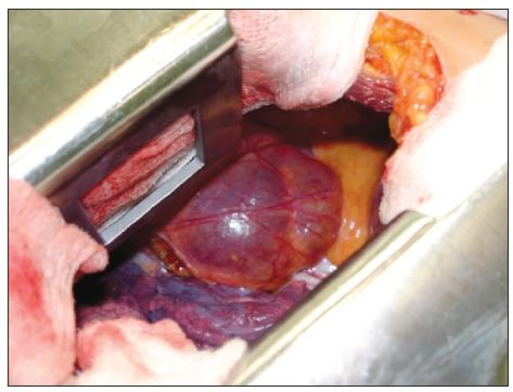 Perikardiální cysta, žena 54 let, operace : VTS / konverze torakotomie – operační foto
Fig. 2. Pericardial cyst, 54-year old female, procedure: VTS / conversion to thoracotomy – intraoperative view
