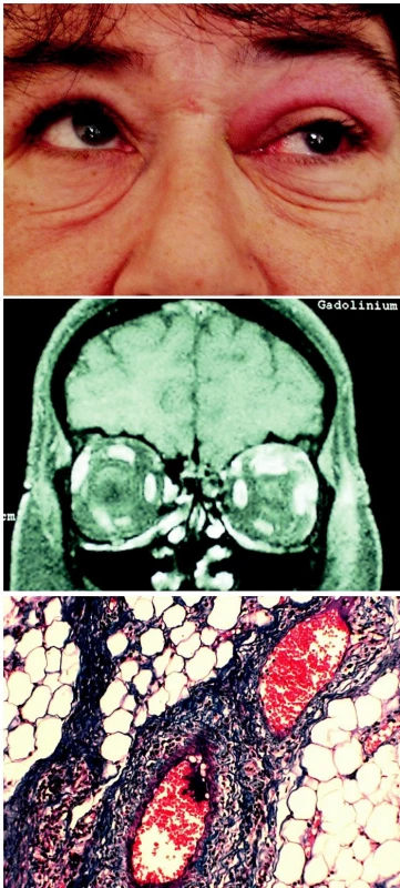 a. Prosáknutí horního víčka vlevo s omezenou elevací bulbu
b. MR: tumor pod stropem pravé očnice s infiltrací horního přímého svalu
c. Histologie: Vaskulitida, parafinový řez, barvení modrý trichrom, zvětšení 125krát
