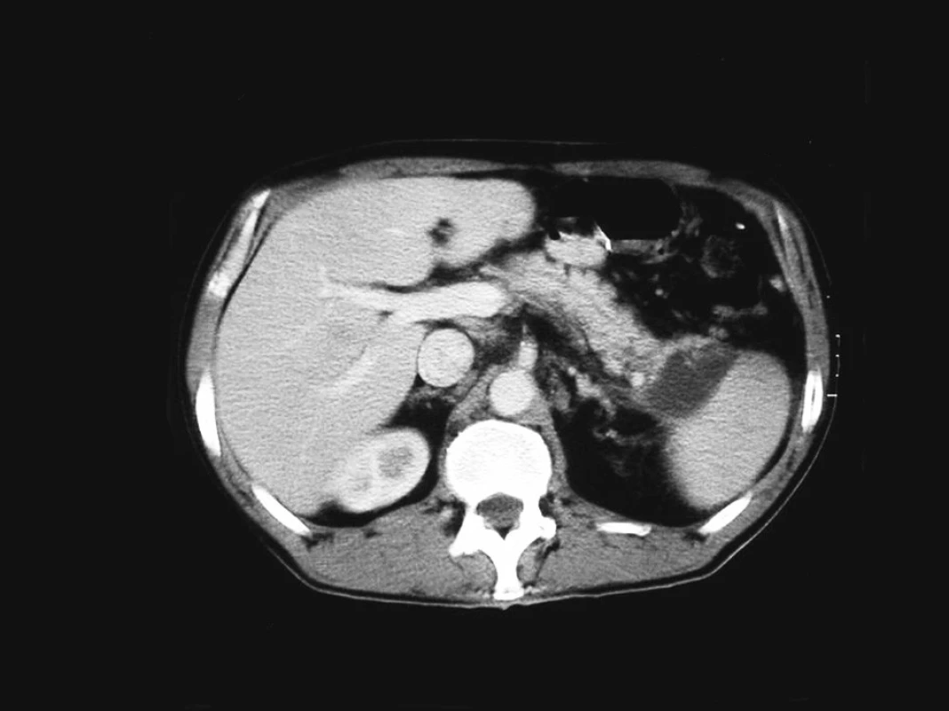 Kontrastní CT sken zobrazující pseudocystu kaudy pankreatu v dubnu 2004
Fig. 1. Contrast CT scan depicting a pseudocyst of the pancreatic cauda, April 2004