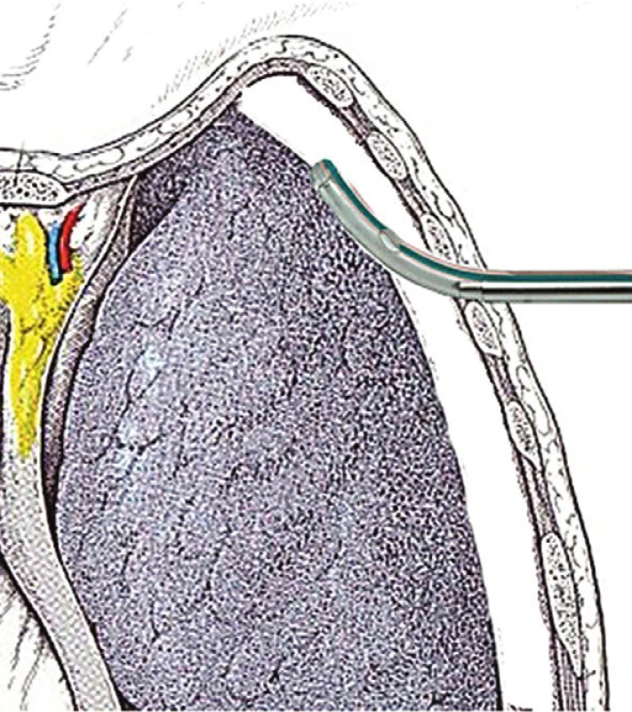 Schéma zavedení hrudního drénu
Fig. 4: Diagram of chest drain insertion