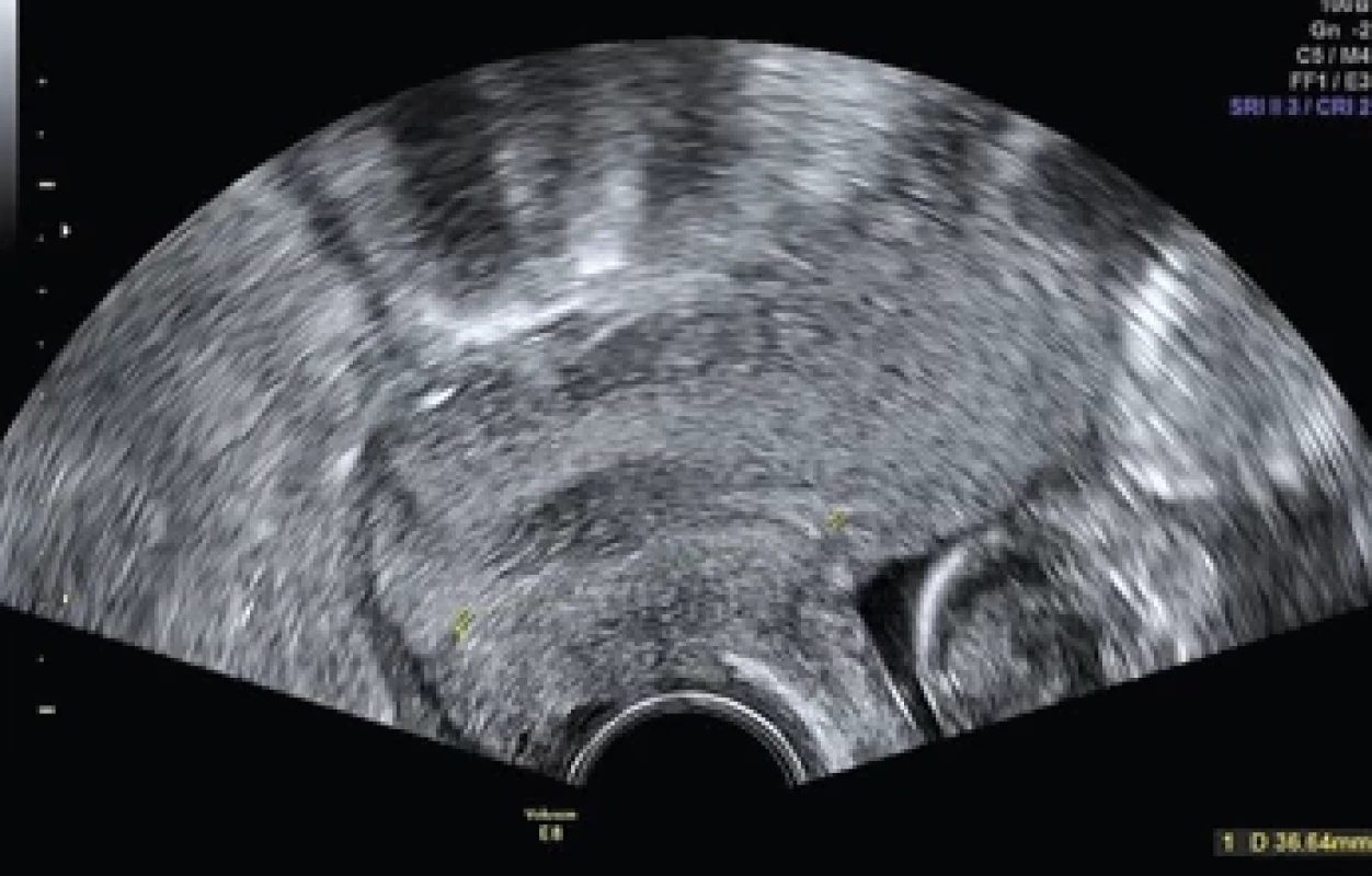 Cervikometrie ve 13. týdnu druhého těhotenství. Fig. 4. Cervicometry in the 13th week of the second pregnancy.
