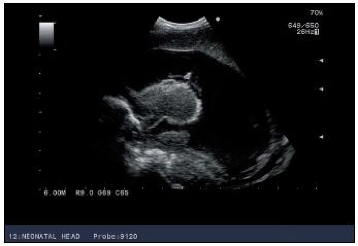 USG vyšetrenie mozgu u novorodenca s progresívnymhydrocefalom– sagitálny rez bočnou mozgovou komorou.
Fig. 2. USG morphometry of brain chambers in a newborn with progressive hydrocephalus – sagital section by side brain chamber.