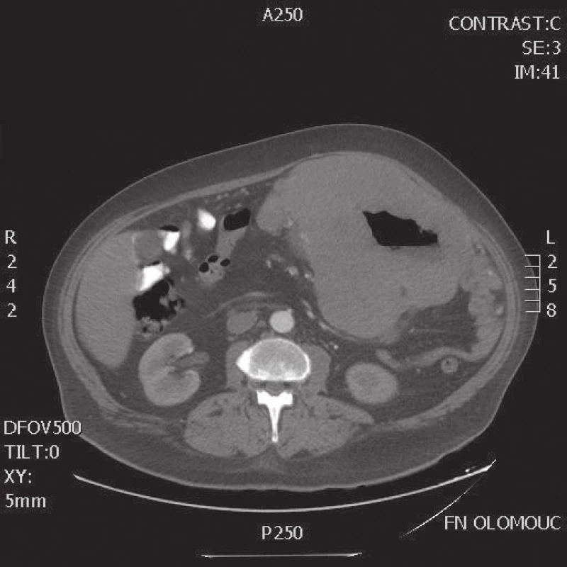CT transverzální řez lymfomu dutiny břišní
Fig. 2: CT scan – transversal view of lymphoma in the abdominal cavity