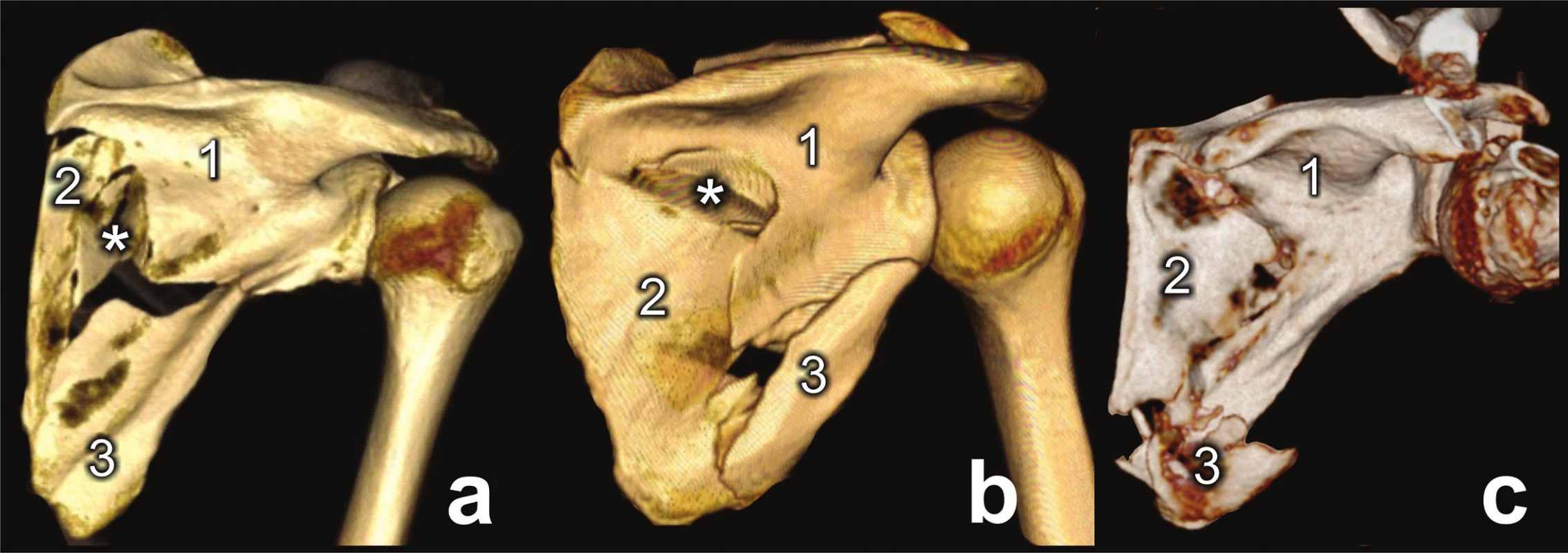 Types of three-part fracture of lateral pillar
a – large inferior angle fragment, 1− glenoid fragment, 2 – inferior angle fragment, 3 – medial border fragment; b – large inferomedial fragment, 1 – glenoid fragment, 2 – lateral border fragment, 3 – large inferomedial fragment; c – large glenoid fragment, 1 – glenoid fragment, 2 – inferior angle fragment, 3 – medial border fragment,* - intercalary fragment.