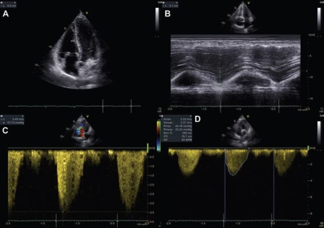 Transthoracic echocardiography at baseline.