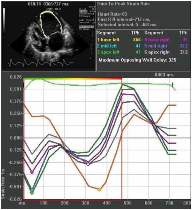 Strain rate zobrazenie mechanickej intraventrikulárnej dyssynchrónie. Jednotlivá krivka predstavuje rýchlosť deformácie príslušného segmentu myokardu (viď vpravo hore). Vrcholové rýchlosti deformácie bielej a najmä žltej krivky sú signifikantne oneskorené (325 ms) v porovnaní s ostatnými krivkami. (materiál kardiologickej klinky LF UPJŠ a VUSCH a.s.)