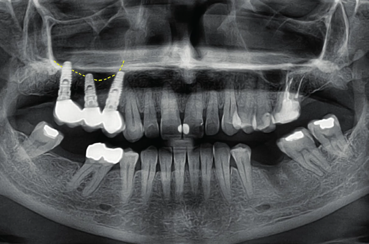 Oba krajní implantáty jsou vykloněny apexem palatinálně od čelistní dutiny, střední implantát míří apexem vestibulárně.
