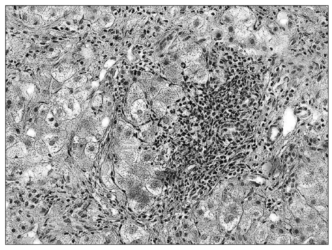 Chronická hepatitída C – výrazná zápalová aktivita parenchýmu (HE, 40x).
Fig. 1. Chronic hepatitis C – a severe inflammatory activity of parenchyma (HE, 40x).