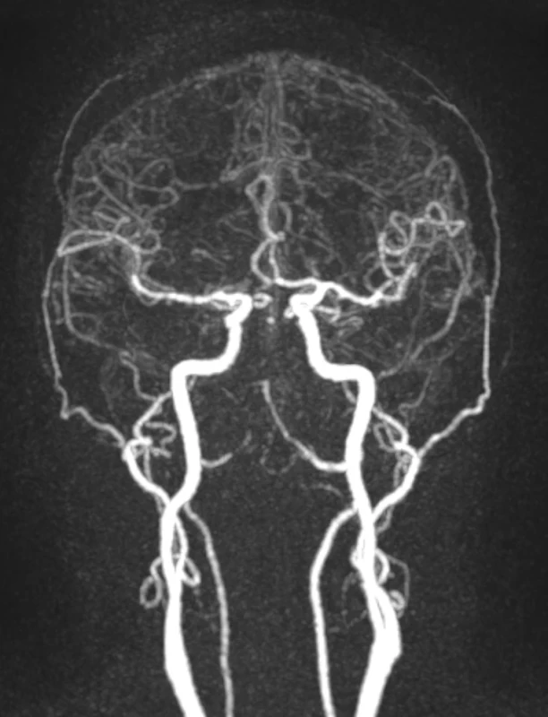 Kontrastní angiografie v koronální rekonstrukci metodou T1 TWIST s defektem náplně v povodí arteria basilaris