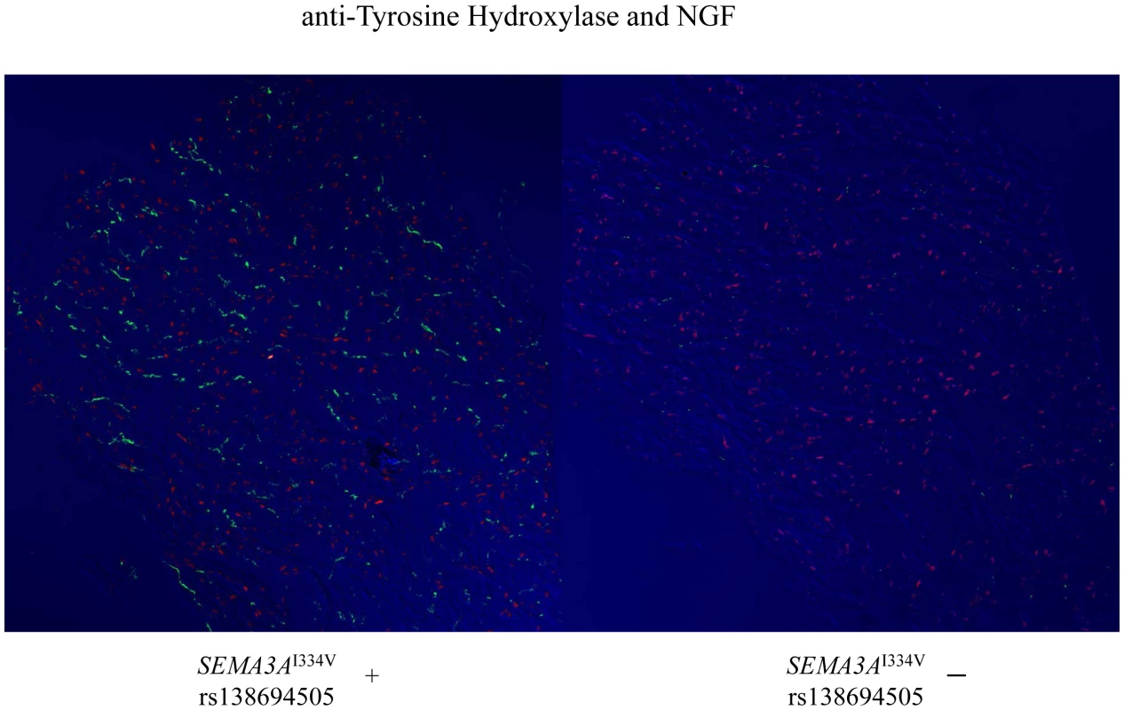 Immunofluorescence staining for Vinculin and NGF in the subendocardial layer of patients with and without <i>SEMA3A</i><sup>I334V</sup>.