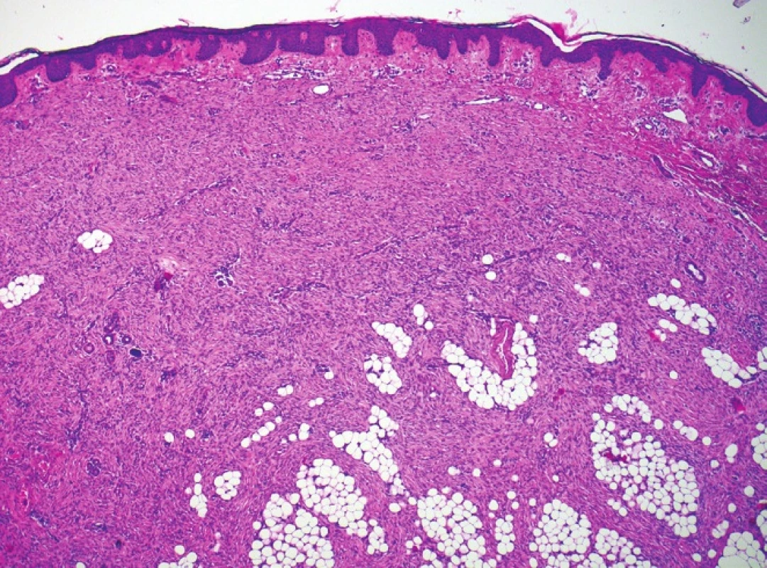 Proliferace vřetenitých buněk zasahující až do podkoží, nodulární část, hematoxylin-eosin, 40krát