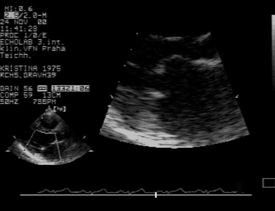 Dvojrozměrná echokardiografie – mitrální stenóza V detailu je zobrazeno fibrózní ztluštění cípů s charakteristickým diastolickým vydouváním předního cípu mitrální chlopně.