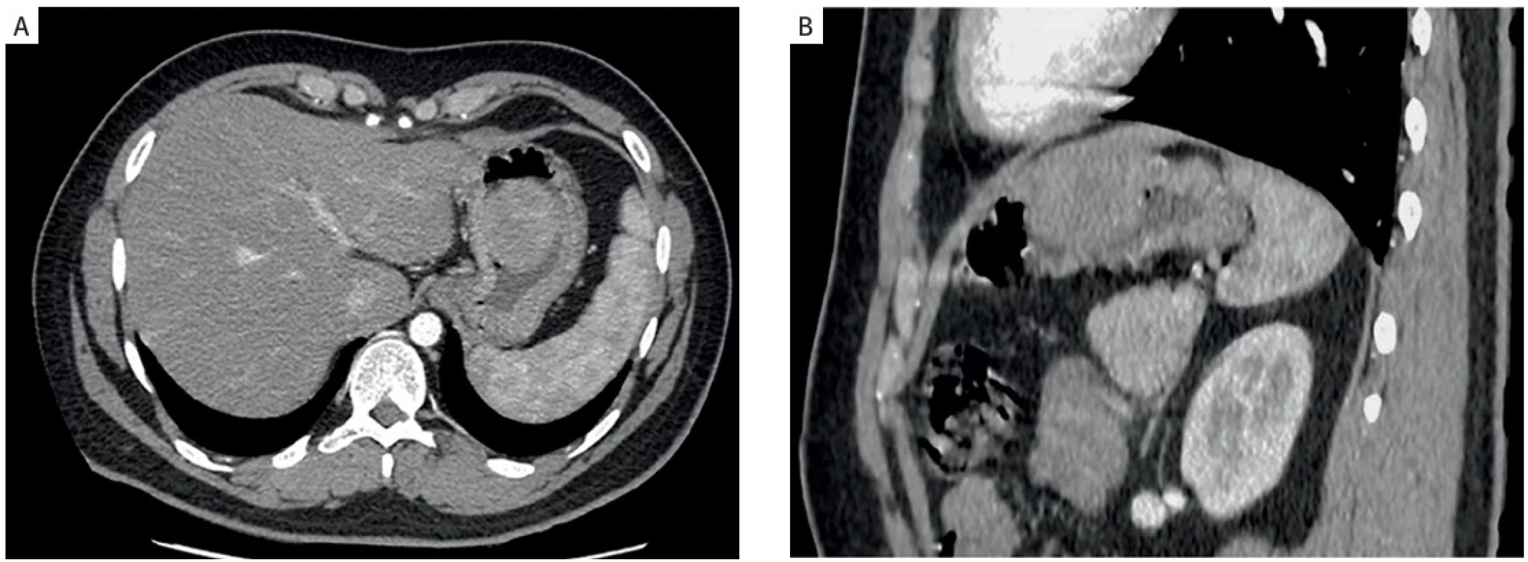  Abdominal enhanced computed tomography. A) Axial view. B) Sagittal view. An abdominal enhanced CT scan showed a contrast- -enhanced round mass on the anterior wall of the stomach, with no evidence of tumour metastasis.  Abdominální počítačová tomografie. A) Transversální pohled. B) Sagitální pohled. Abdominální vylepšené CT vyšetření  ukázalo kulatou hmotu s kontrastem na přední stěně žaludku bez známek metastázy tumoru.
