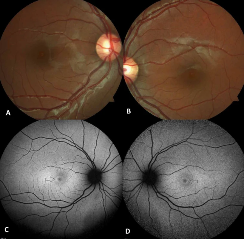 Barevné snímky očního pozadí pravého (A) a levého (B) oka byly normální. Snímky autofluorescence očního pozadí ukázaly perifoveální prstenec hyperautofluorescence (černá šipka) v pravém (C) a levém (D) oku