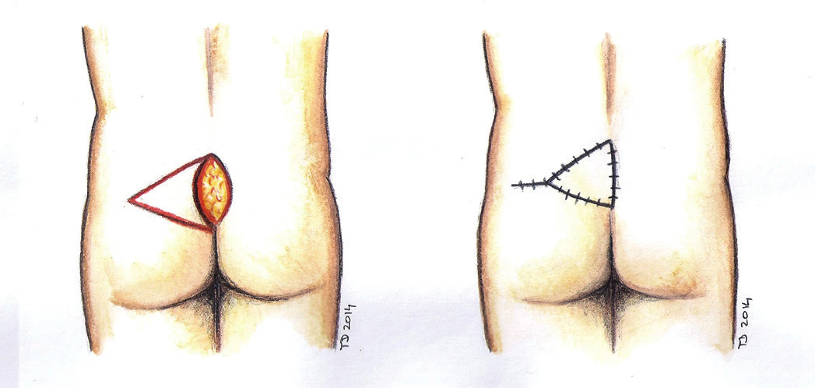 V-Y posun - schéma
Fig. 5: V-Y advancement flap - scheme