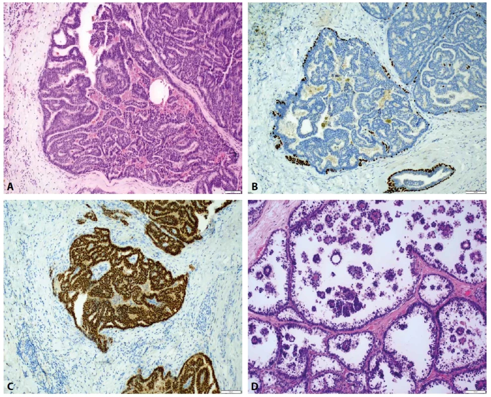 Papilární DCIS a mikropapilární DCIS. A. V přehledu papilárně konfigurovaný DCIS (HαE, zvětšení 40x). B. Myoepitelie pozitivní v p63 jsou zachovalé prakticky pouze v obvodu duktu, v papilárních strukturách je patrna absence (p63, zvětšení 100x). C. ER je difuzně pozitivní v neoplastické populaci (ER, zvětšení 100x). D. Pro porovnání morfologie mikropapilární DCIS s absencí osových stromálních papil (HαE, zvětšení 100x).